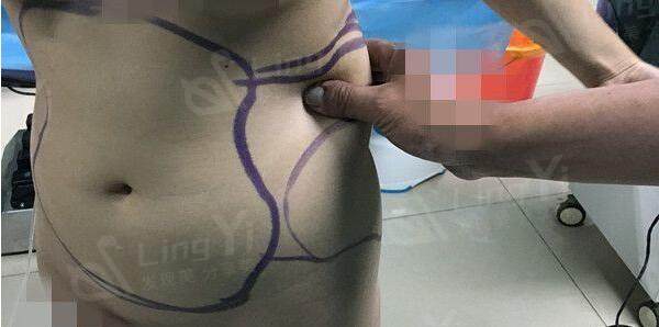 女性腰腹吸脂手术全过程实录分享