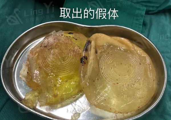 隆胸假体取出手术过程痛苦吗