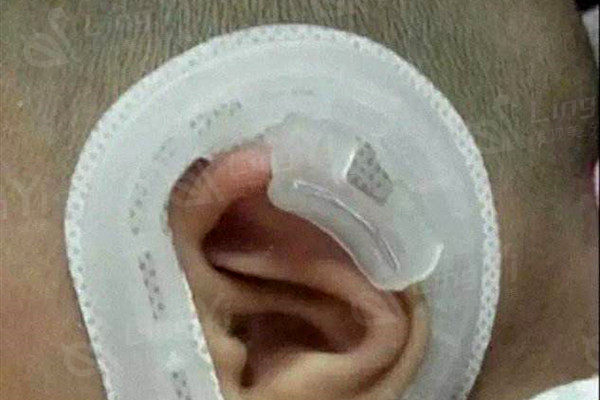 隐耳畸形怎么矫正