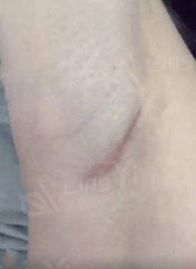 隆胸术前术后的注意事项