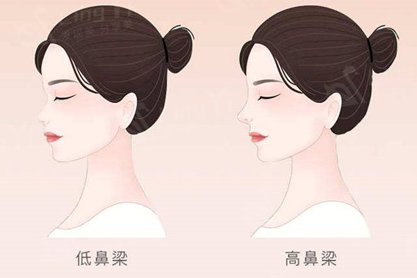 隆鼻不满意可以免费修复吗