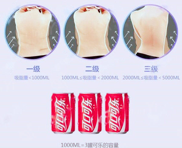 腰腹吸脂3000毫升能瘦多少斤