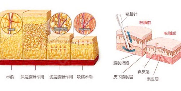 吸脂瘦身示意图