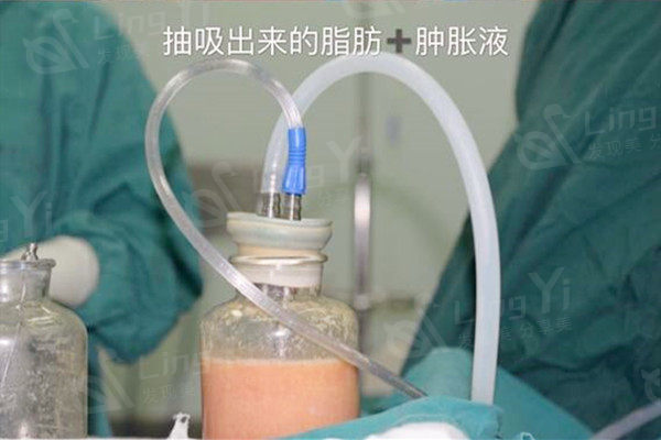水动力吸脂手术