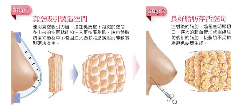 自体脂肪隆胸