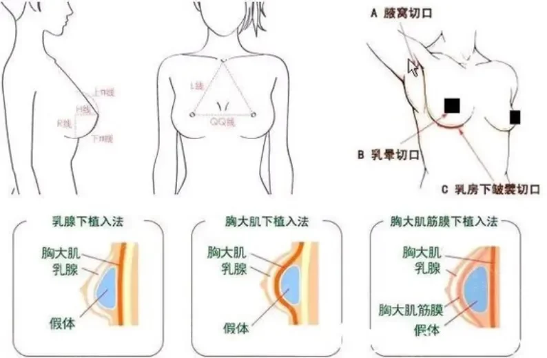假体隆胸