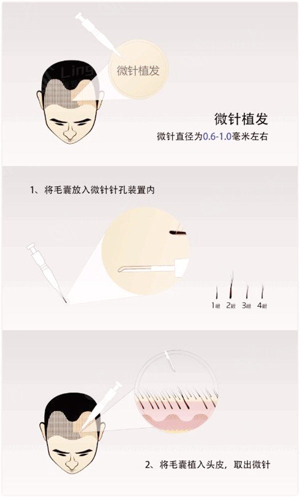 微针植发技术