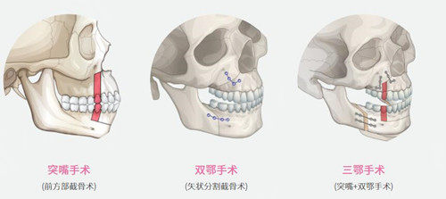 三鄂手术