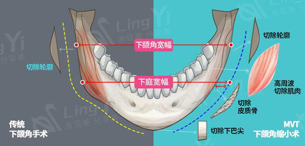 下颌角.jpg