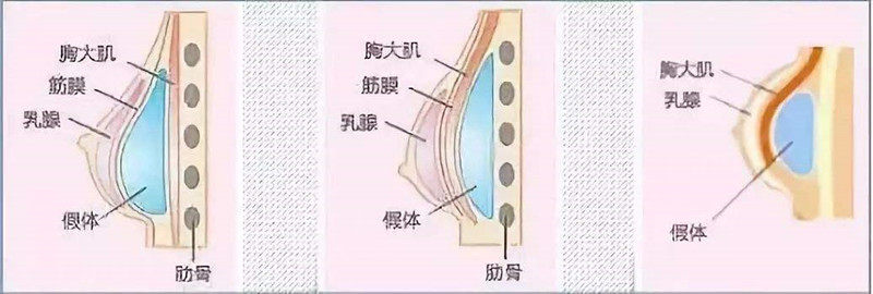 做完假体隆胸后多久能变软啊