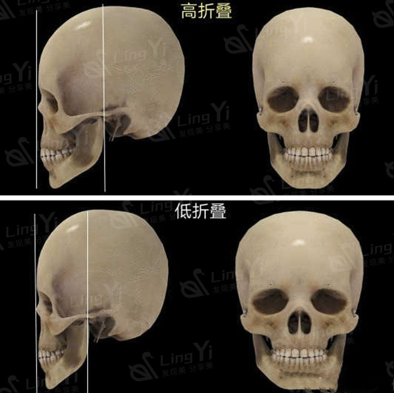 然后你就会知道在面部轮廓整形手术中,有颧骨整形手术,颧弓整形手术