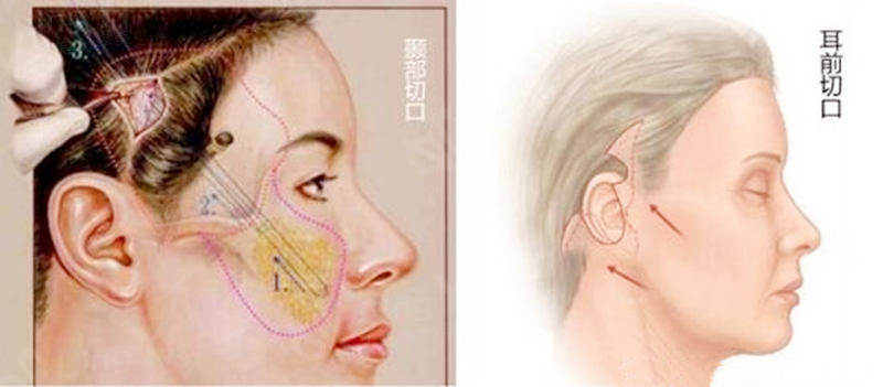 拉皮手术后悔衰老更快,是真的吗