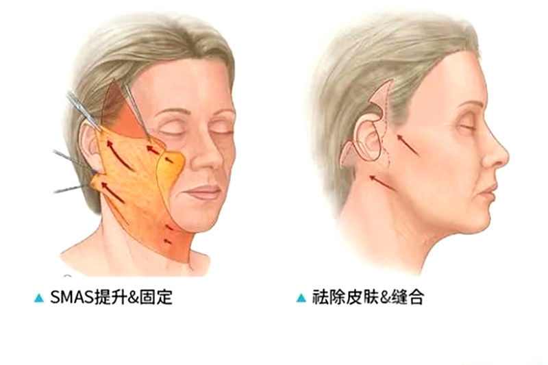 内窥镜拉皮和普通拉皮的区别