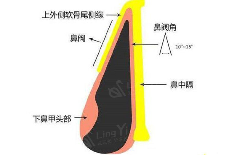 内鼻阀角度小的人群不能做