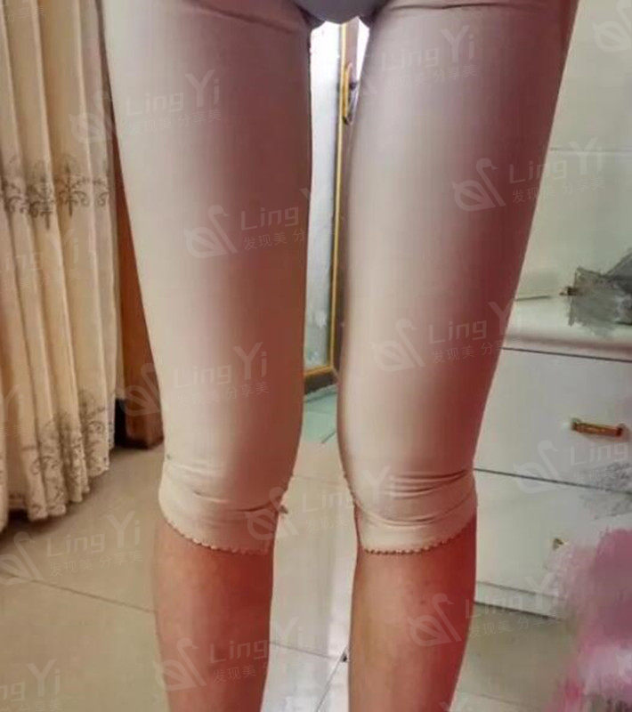 吸脂后的大腿