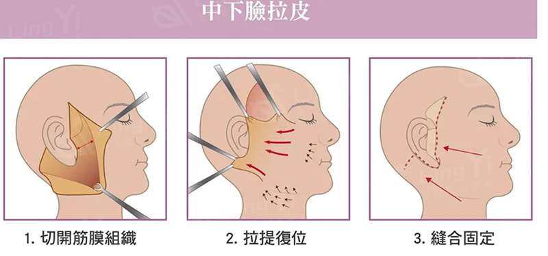 当皮肤松弛时候医生为什么建议做拉皮手术