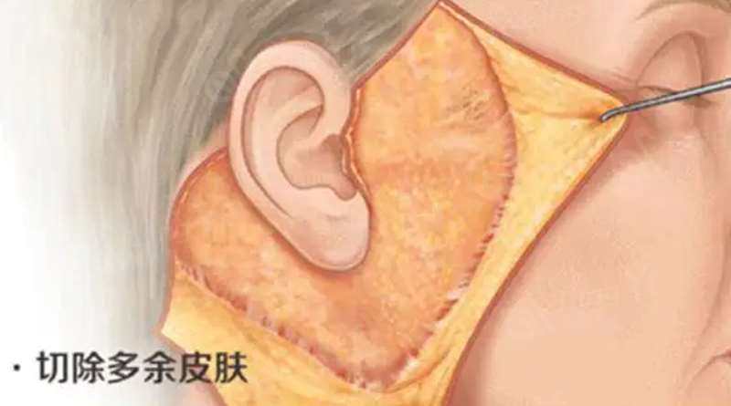 当皮肤松弛时候医生为什么建议做拉皮手术