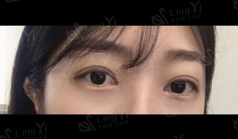 韩国大眼睛整形做双眼皮怎么样