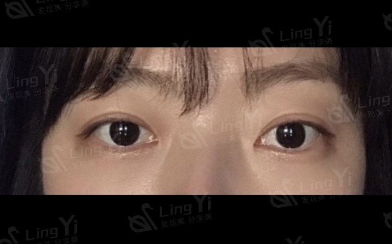 韩国大眼睛整形做双眼皮怎么样