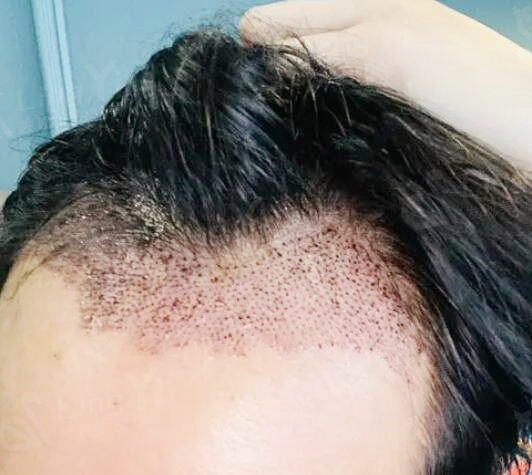 男生植发际线前后对比照片,发际线后移的问题有救了-整形资讯-灵伊网