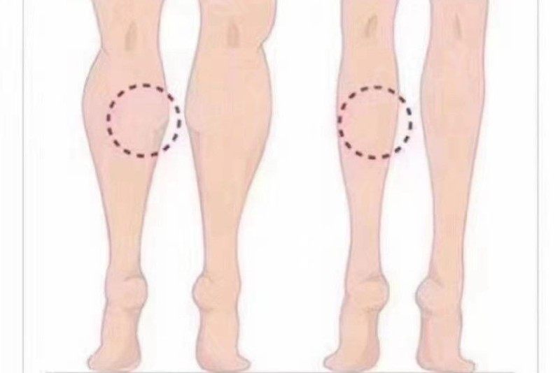 肌肉型小腿怎么瘦？3个方法教你秒变纤细美腿