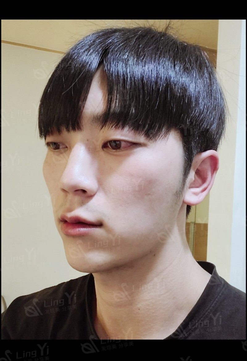 男生颧骨太突出怎么改善?