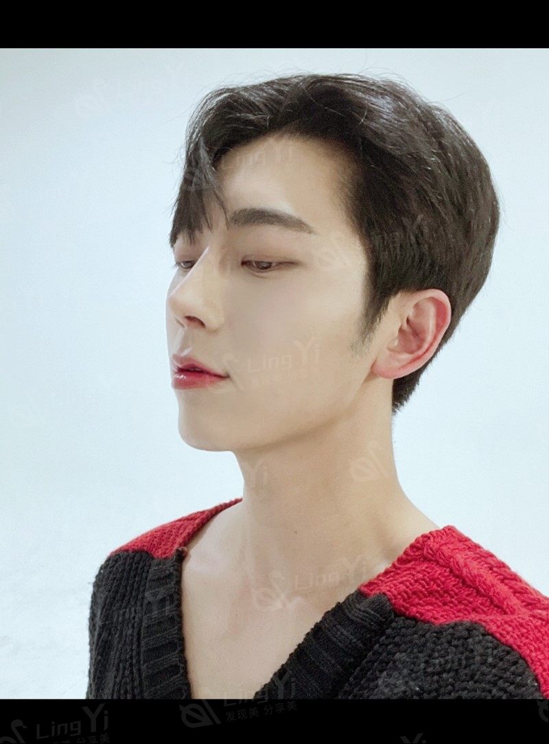 男性面部轮廓整形手术前后对比