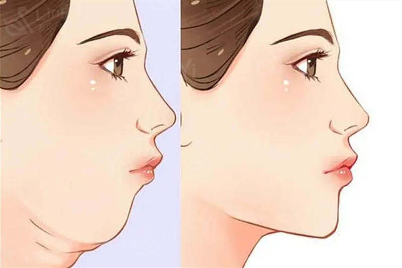 在韩国做了面部脂肪移植+双下巴吸脂的反馈来了 真的好看！