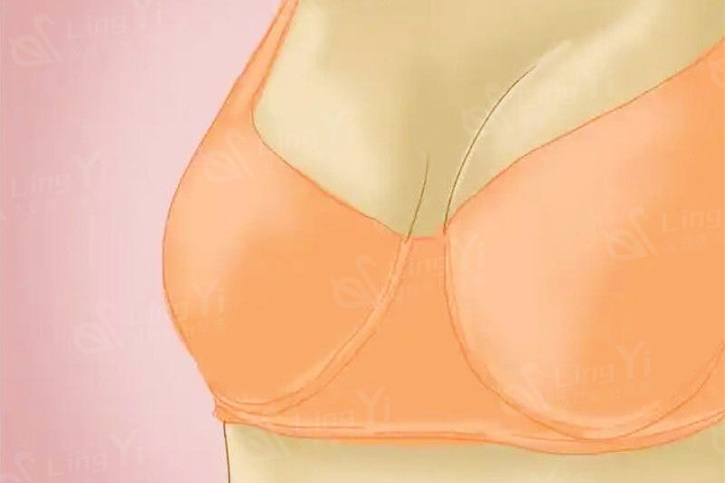 内衣真的可以调整胸型吗？比如说外扩、下垂、收副乳的情况