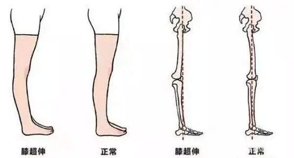 膝超伸的表现