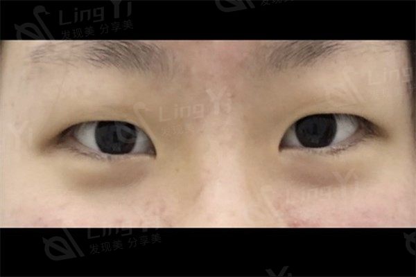 韩国眼综合手术前后对比图分享，肿眼泡秒变小鹿眼