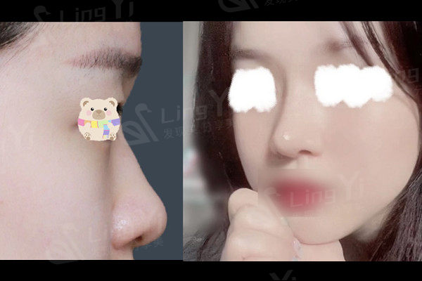 韩国综合整形手术术后分享，一并解决了大鼻头、歪鼻的情况