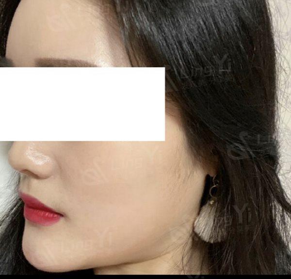 "月牙脸"变美实记 轮廓不改变做再多项目也白搭