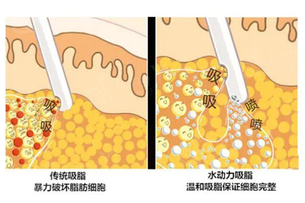 韩国吸脂好的医院良心推荐，这五家本地人比较认可