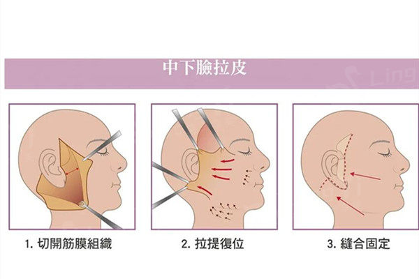 除了拉皮还有什么可以提升面部？热玛吉/埋线/筋膜悬吊哪个适合我