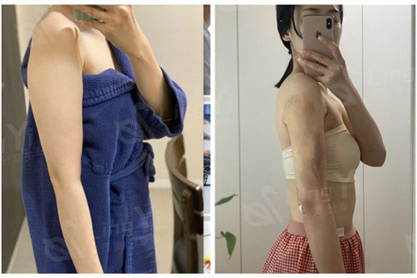 韩国做手臂吸脂手术恢复图