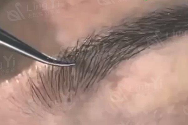 在韩国布莱克医院做了眉毛移植手术后，分享植眉毛的过程及处理方法