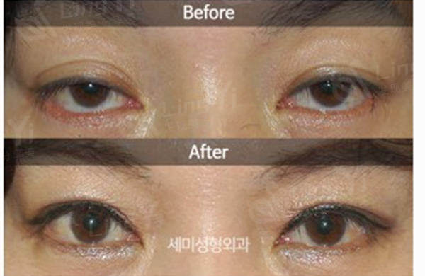 韩国世美整形医院眼睛修复收费贵吗