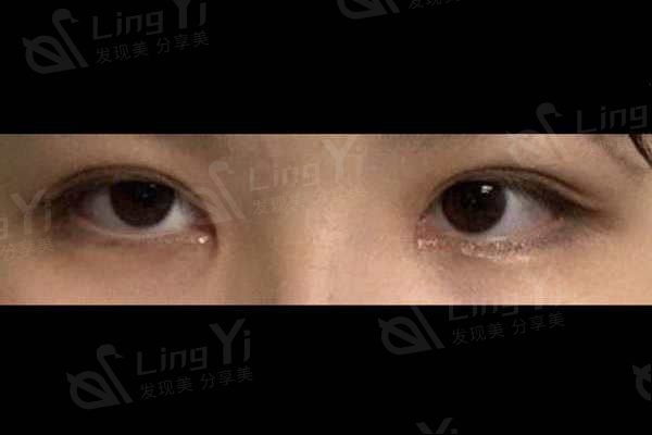 韩国双眼皮医生技术怎么样？韩国双眼皮+开内眼角前后对比超满意
