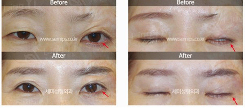 世美下眼睑外翻前后对比照