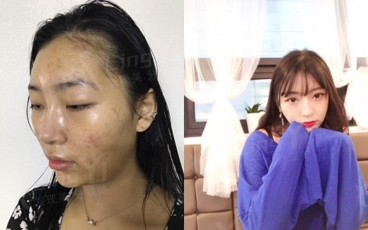 尹昶云做双鄂手术前后对比图