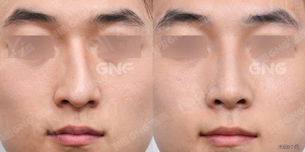 韩国GNG医院鼻整形前后对比图