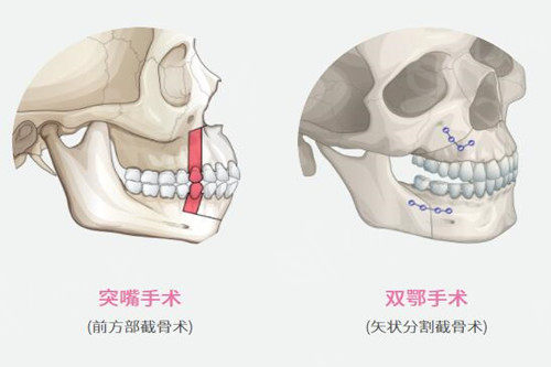 正颌手术