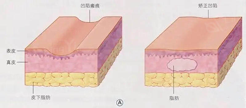 脂肪填充