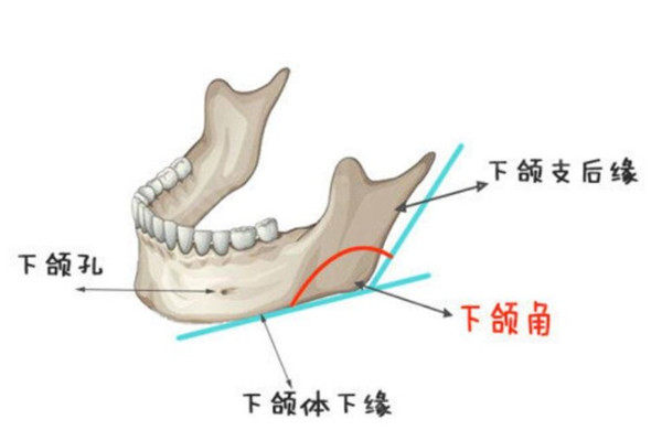 下颌角整形