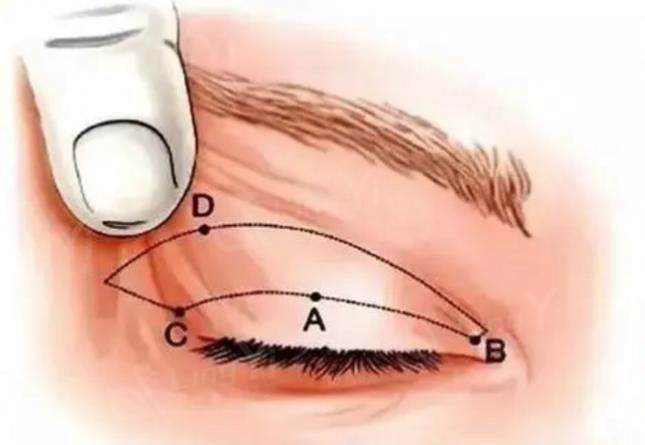 上眼睑下垂 上眼睑下垂
