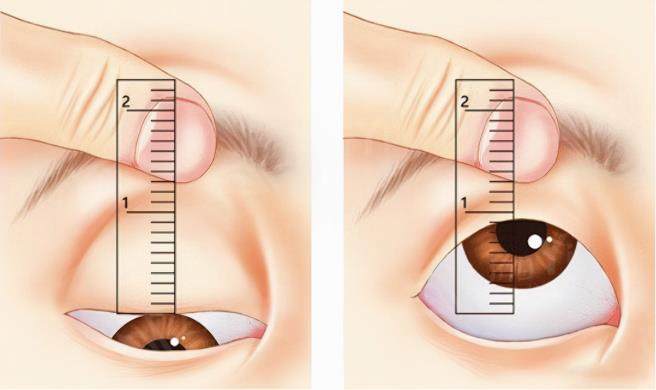 上眼睑下垂矫正 上眼睑下垂矫正