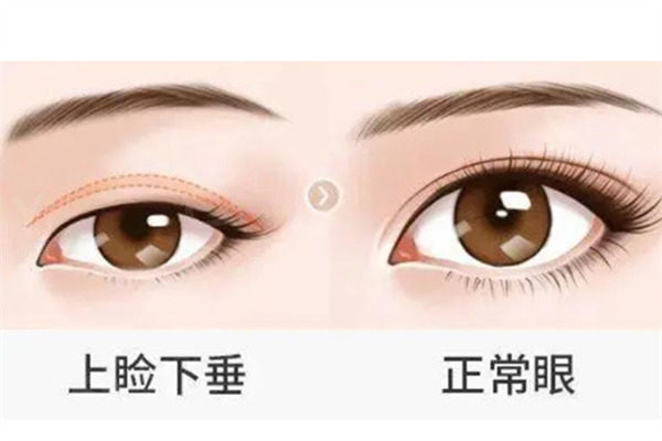 全面分析上眼睑下垂怎么矫正?及手术较佳年龄