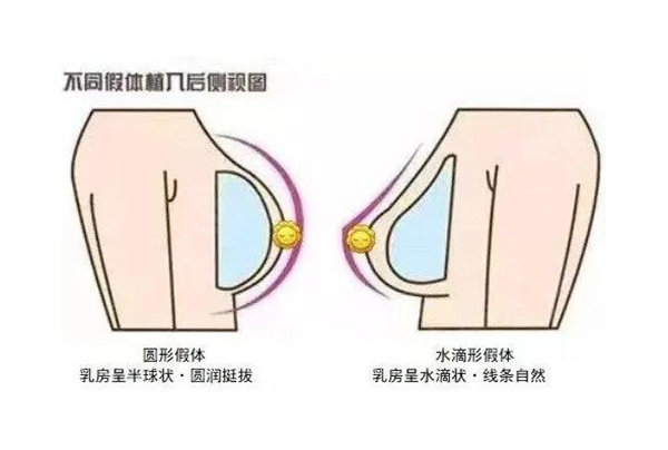 隆胸