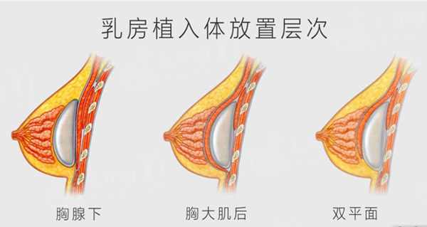双平面隆胸